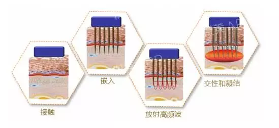 黄金微针